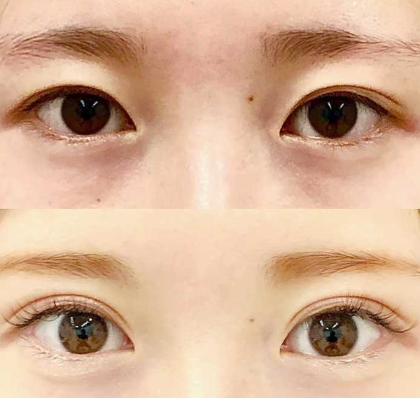 西京醫(yī)院雙眼皮價(jià)格多少